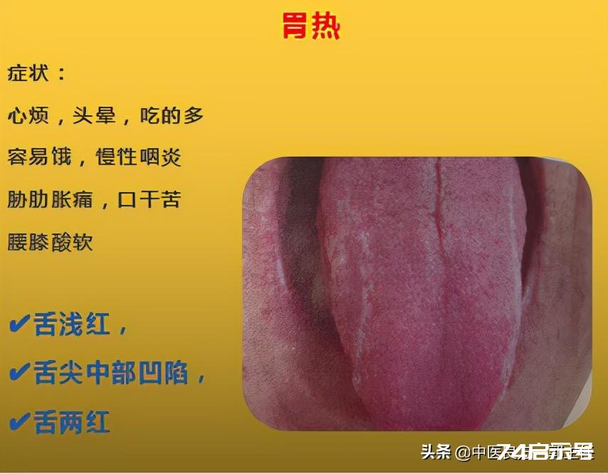 12种“热”藏于体内，反应的舌象、症状各不相同，自查便知
