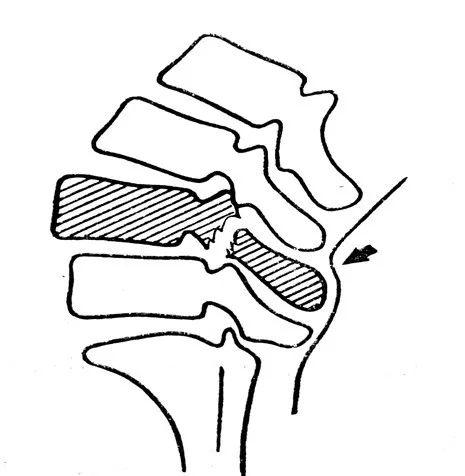 腰椎滑脱的影像学表现及治疗(推拿整复法)