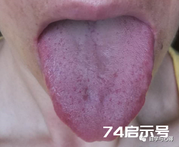 舌诊——望舌色诊病——红舌