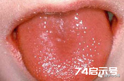 舌诊——望舌色诊病——红舌