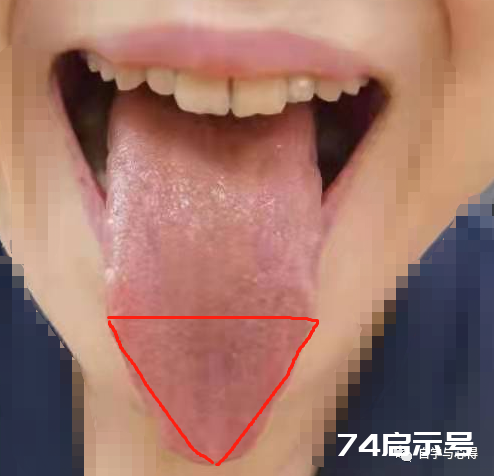 舌诊——望舌形诊病——三角舌