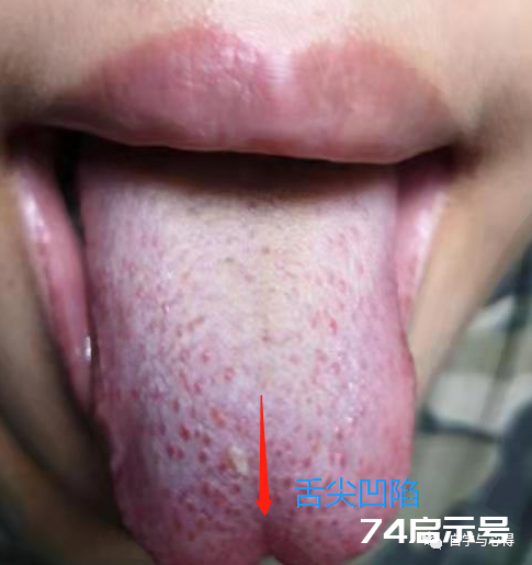 舌诊——望舌形诊病——舌体凹凸