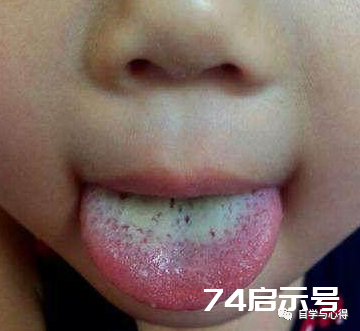 舌诊——望舌色诊病——淡红舌