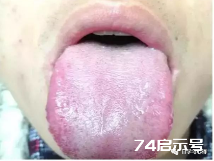 舌诊——望舌形诊病——肿胀舌与胖大舌