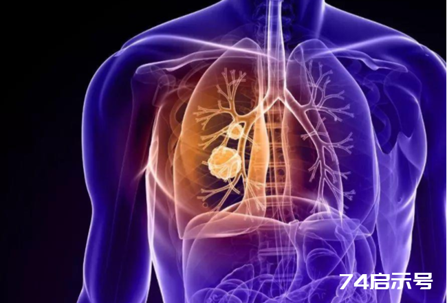 体检查出肺结节，肺癌的可能性有多大