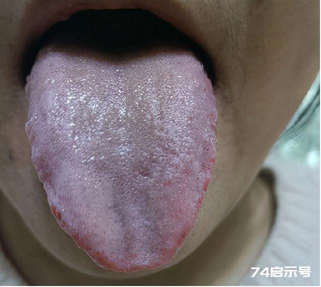 淤血难化？舌象告诉你原因，两味中药、化痰活血、去瘀生新