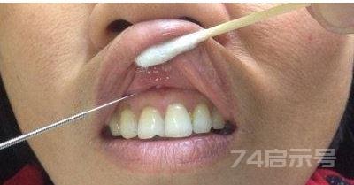 倪海厦针灸笔记（七三）——牙痛合谷（奇穴）