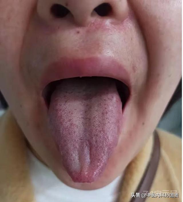 从舌头看健康，舌诊案例分析：拍下你的舌象，我帮你辩证
