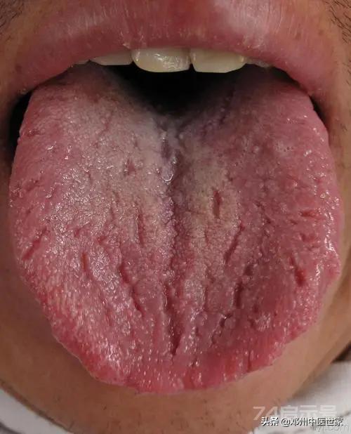 什么是裂纹舌， 为什么有的人舌头上纵横沟壑一层裂纹舌头为什么有裂纹呢？心不足舌裂、脾不足唇干，心血充...