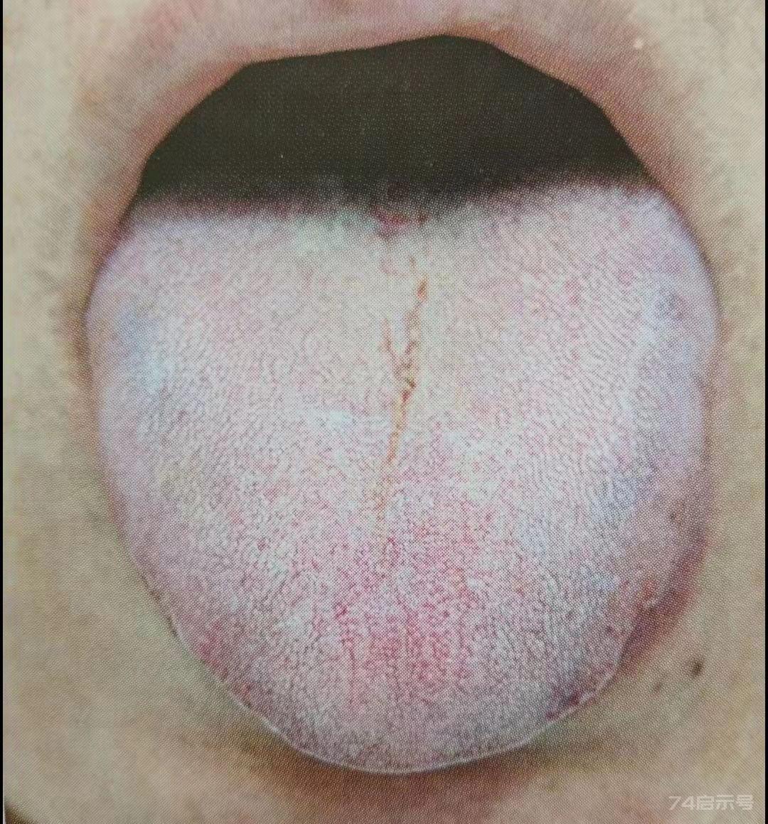 青紫舌诊断