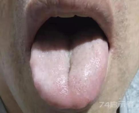 舌中有裂纹说明什么问题？胃炎还是肾虚？医生教你一招区分