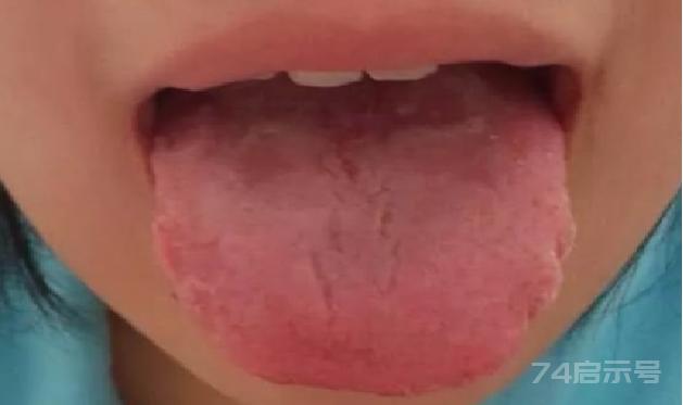 舌头上有裂纹是怎么回事？分享五种中成药，帮你消除5种裂纹舌