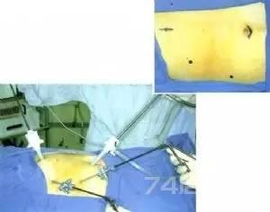 图解腹腔镜胆囊切除术手术过程