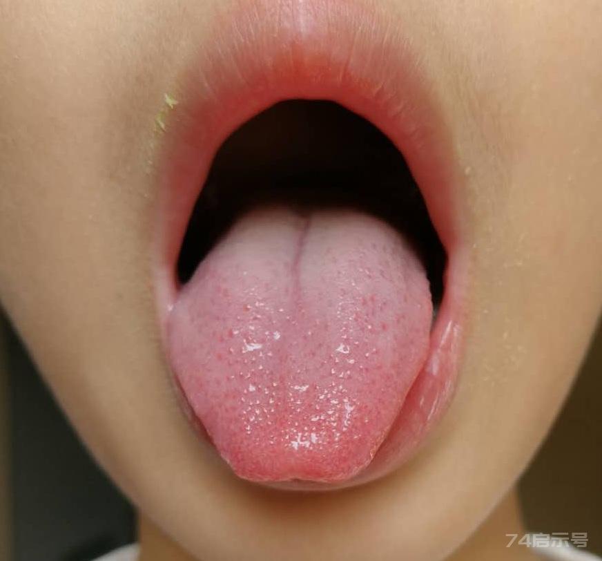 舌边有齿痕多半是脾虚湿气重，中医教你健脾利湿祛湿