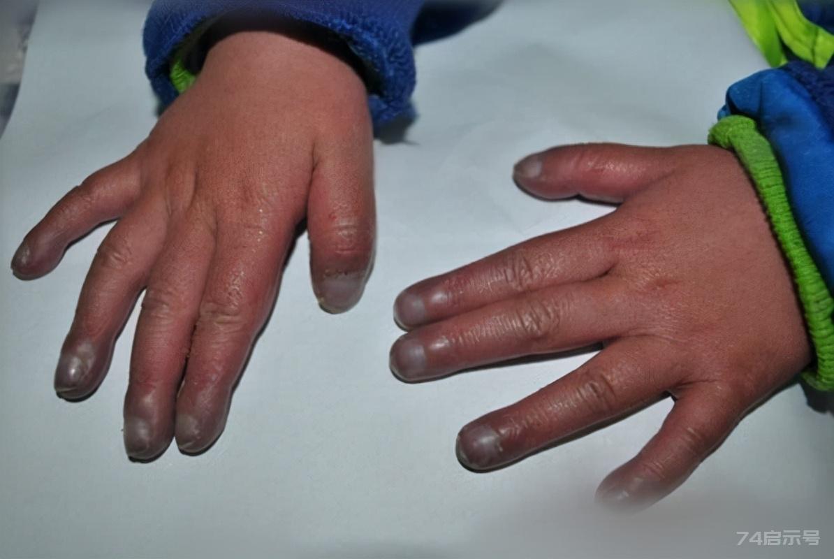 【疾病诊疗】身体有病手指先知？提醒：警惕手指出现的7种变化，或是疾病来袭