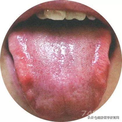 临床常见的120多种舌苔图谱（彩色超清），值得收藏