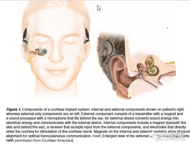 【伽玛刀探索】神经纤维瘤病2型和双侧前庭神经瘤能否使用伽玛刀治疗结合人工耳蜗植入？