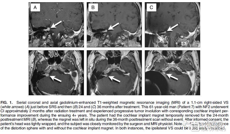 【伽玛刀探索】神经纤维瘤病2型和双侧前庭神经瘤能否使用伽玛刀治疗结合人工耳蜗植入？