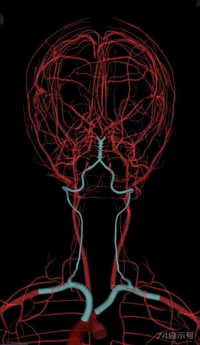 浅谈颈部解剖之“椎动脉”
