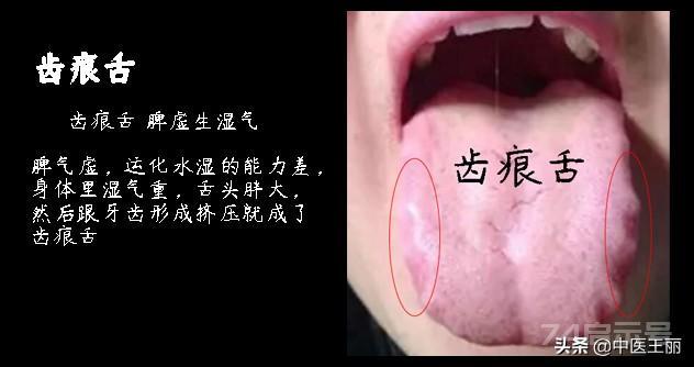 舌尖在最上方，就对应人的上焦，也就是心肺舌头中部在中间，就对应人的中焦，也就是脾胃舌头根部在下方...