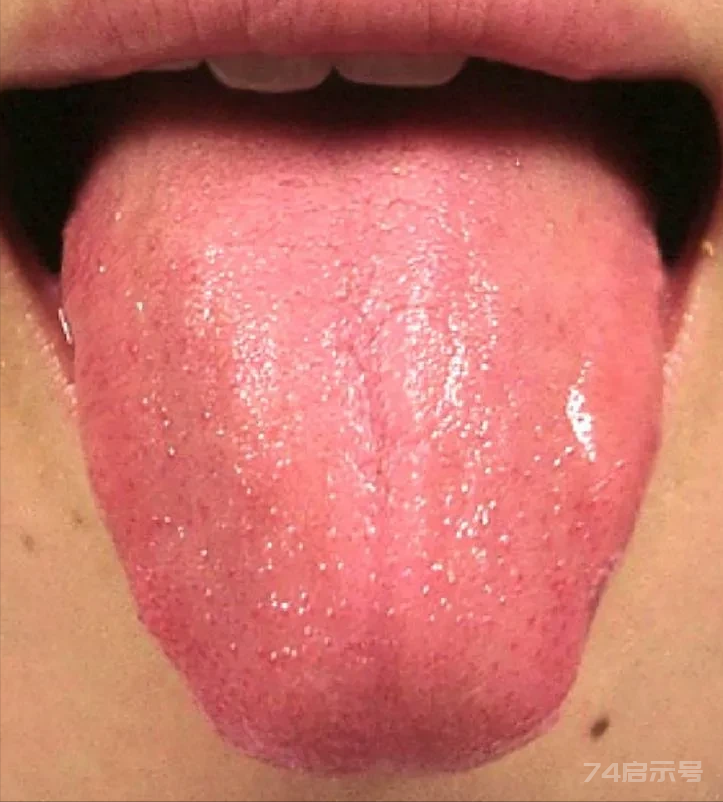 中医最常见的几种舌像，看看你是属于哪一种？