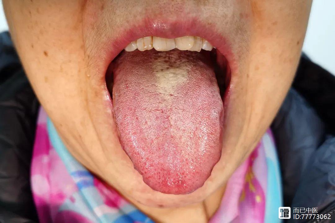 舌诊第三十讲：上焦有热、下焦积湿之舌，孙思邈的一张小方可上下同解！