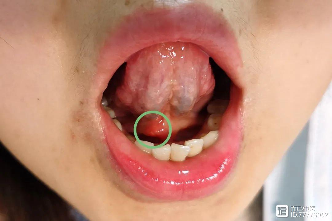 舌诊第三十二讲：从一例急性阑尾炎，看阑尾在舌诊的定位