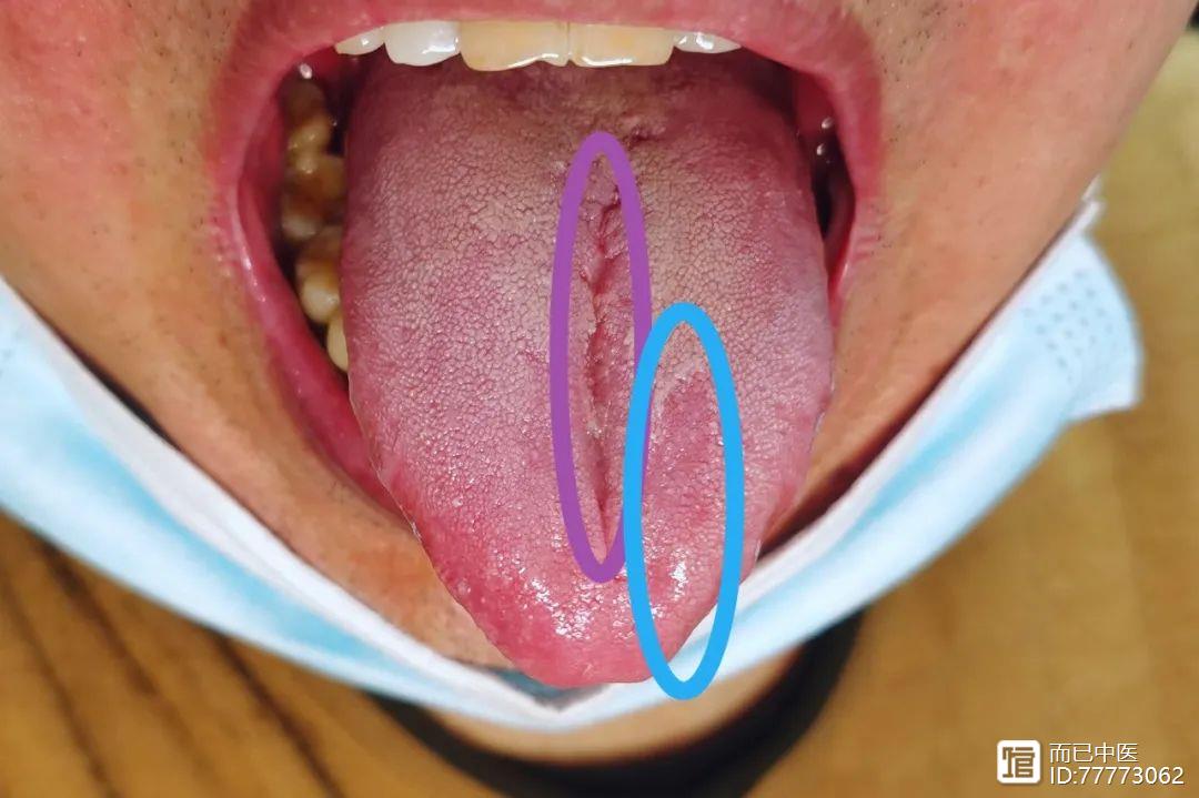 舌诊第三十四讲：肺阴虚之舌，发人深思之舌！