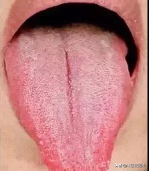 齿痕舌、裂纹舌，舌下青筋是怎么回事