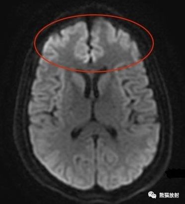 急/慢性肝性脑病丨MRI表现