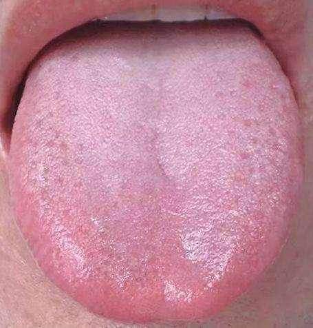 舌头有齿痕，不只是脾虚湿重！