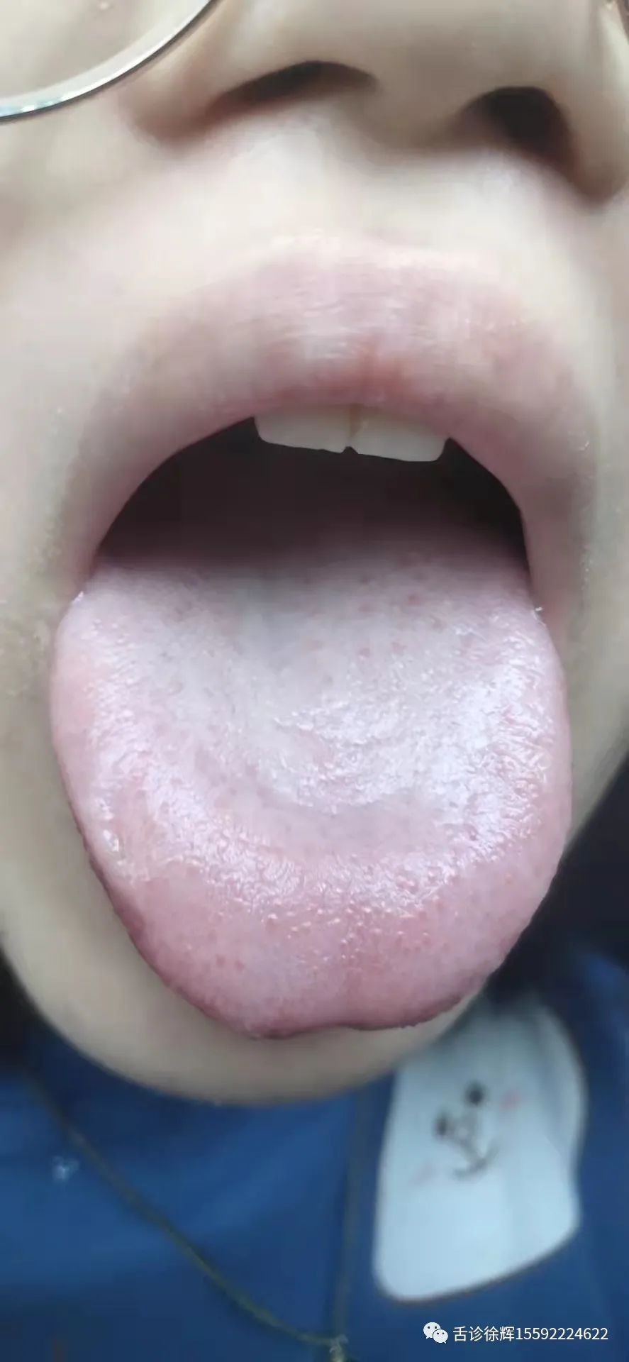舌像分析：大便干燥，痛经