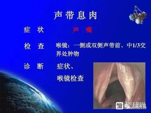 能治疗声带小结、声带息肉的中成药，依据《中国药典》2015版