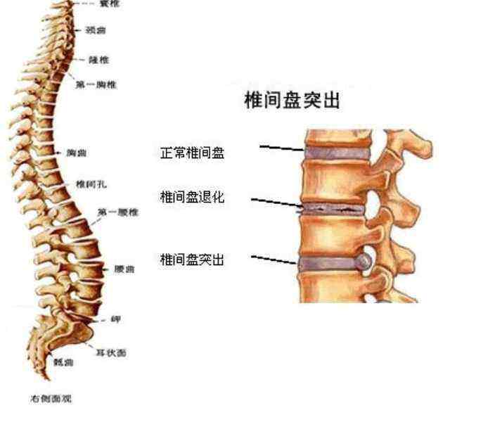 腰椎间盘突出的原因和恢复的方法
