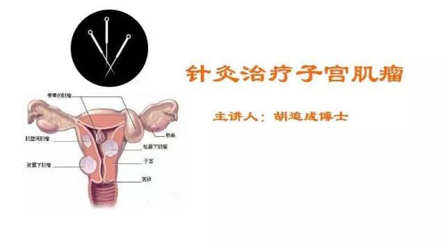 针灸治疗子宫肌瘤特效穴位--曲骨、横骨和子宫穴