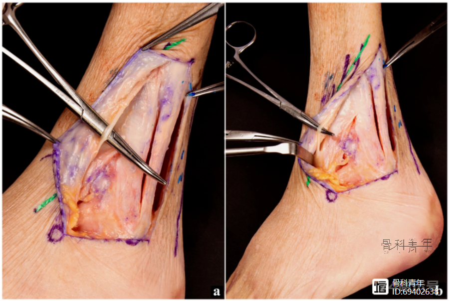 一种直接显露“三踝（前踝、外踝、后踝）”的手术入路