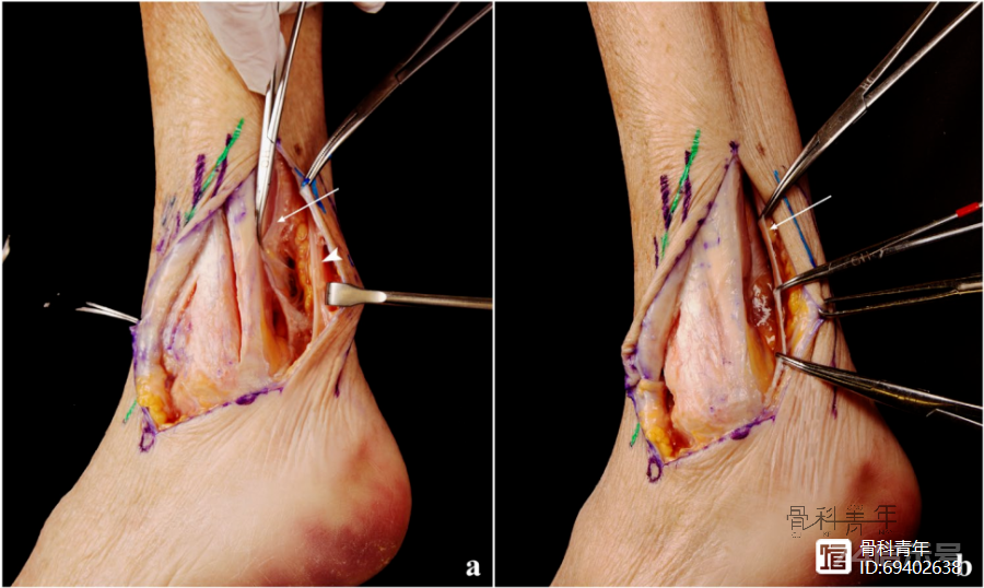 一种直接显露“三踝（前踝、外踝、后踝）”的手术入路