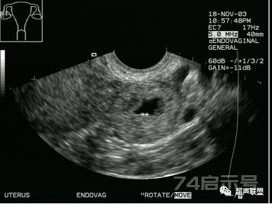 宫外孕的超声诊断