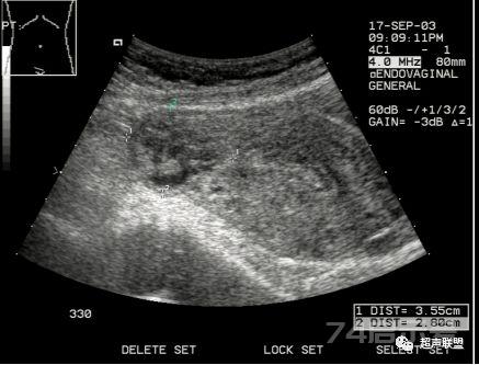 宫外孕的超声诊断