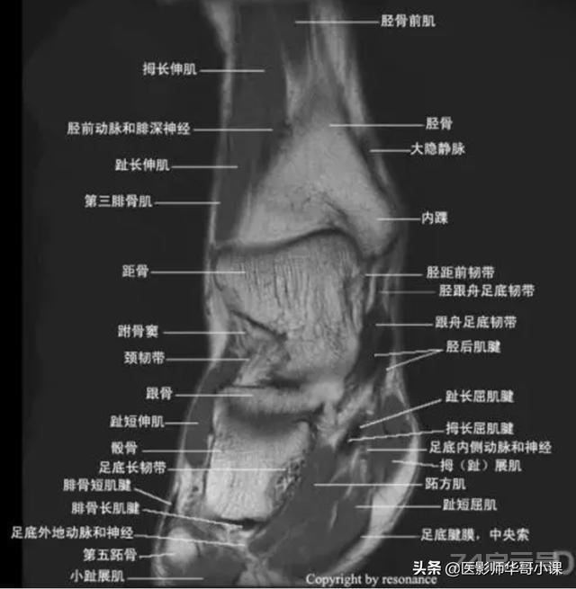 踝关节磁共振（MRI）解剖--精品图集