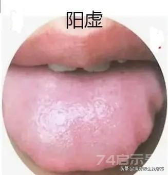 【常见舌苔辨证——对症中成药】舌头是身体...