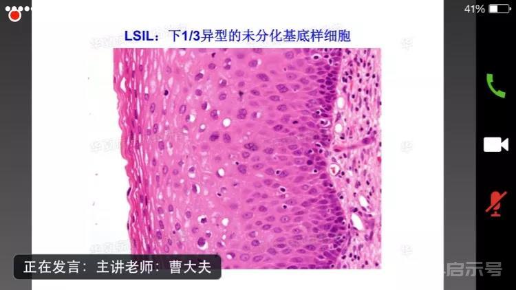 曹登峰老师妇科肿瘤免疫组化表达的课后小结（副本）