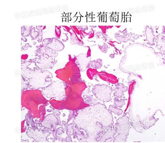 曹登峰老师妇科肿瘤免疫组化表达的课后小结（副本）