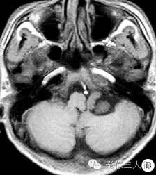 【读片时间】第0862期：左侧桥小脑角区脉络丛乳头状瘤