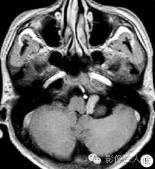 【读片时间】第0862期：左侧桥小脑角区脉络丛乳头状瘤