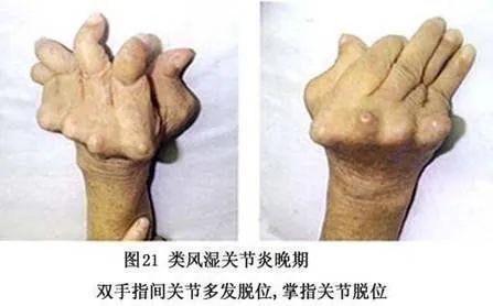 类风湿性关节炎手指关节已变形 特效药：乌头桂枝汤 倪海厦医案