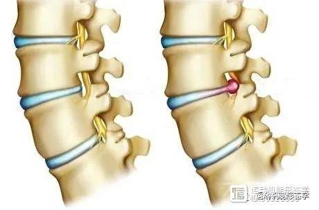 椎间盘的结构特点与腰椎间盘突出症
