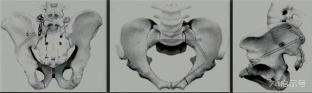 “学术大餐”—面面俱到讲解骨盆后环骨折的固定方案