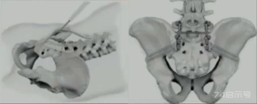 “学术大餐”—面面俱到讲解骨盆后环骨折的固定方案