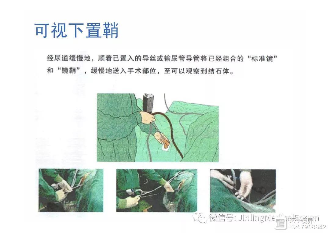 『吕建林』:硕通镜在尿结石治疗中的应用